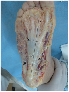 Plantar fascial rupture Medical condition