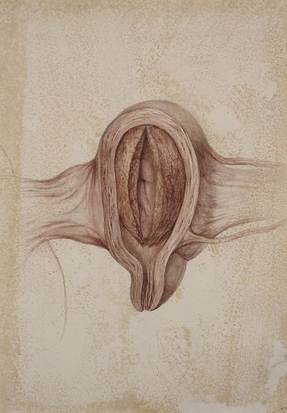 File:Uterine fibroid Wellcome L0061318.jpg