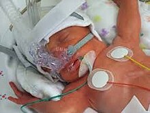 A newborn wearing a nasal CPAP device. CPAP NASAL.jpg