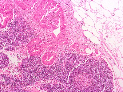 Micrograph of a mesenteric lymph node with adenocarcinoma