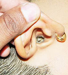 Earwax in ear Ear Wax.JPG