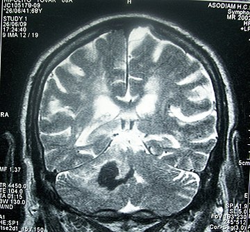 Accidente cerebrovascular