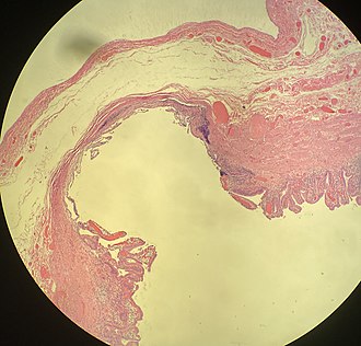 Histopathology of the gallbladder, showing a false diverticulum (larger than a Rokitansky-Aschoff sinus). It is not true, as the muscularis layer is essentially absent over the diverticulum rather than bulging outward. Histopathology of a false diverticulum of the gallbladder.jpg