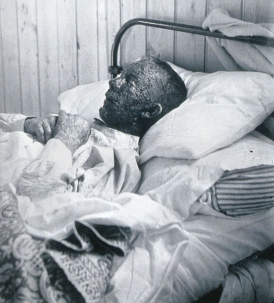 File:Malignant smallpox.jpg