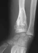 March 25: X-ray of a girl's wrist, with enchondromas in the radius.