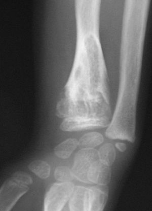 multiple enchondromatosis histology