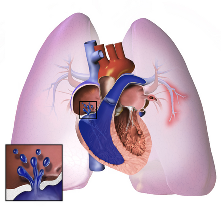 Diagram showing increased pressure in the arteries of the lungs.