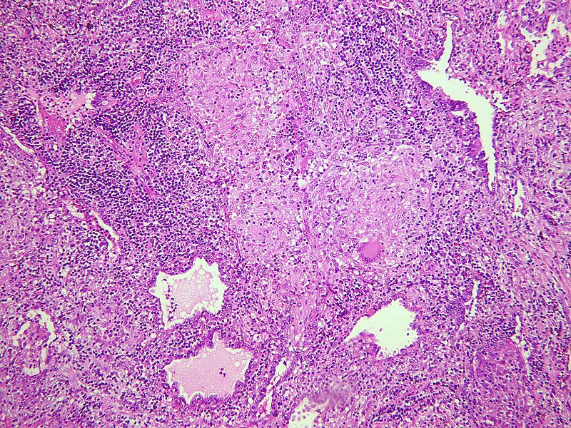 File:Pulmonary tuberculosis - Non-necrotizing granulomas (6545184379).jpg