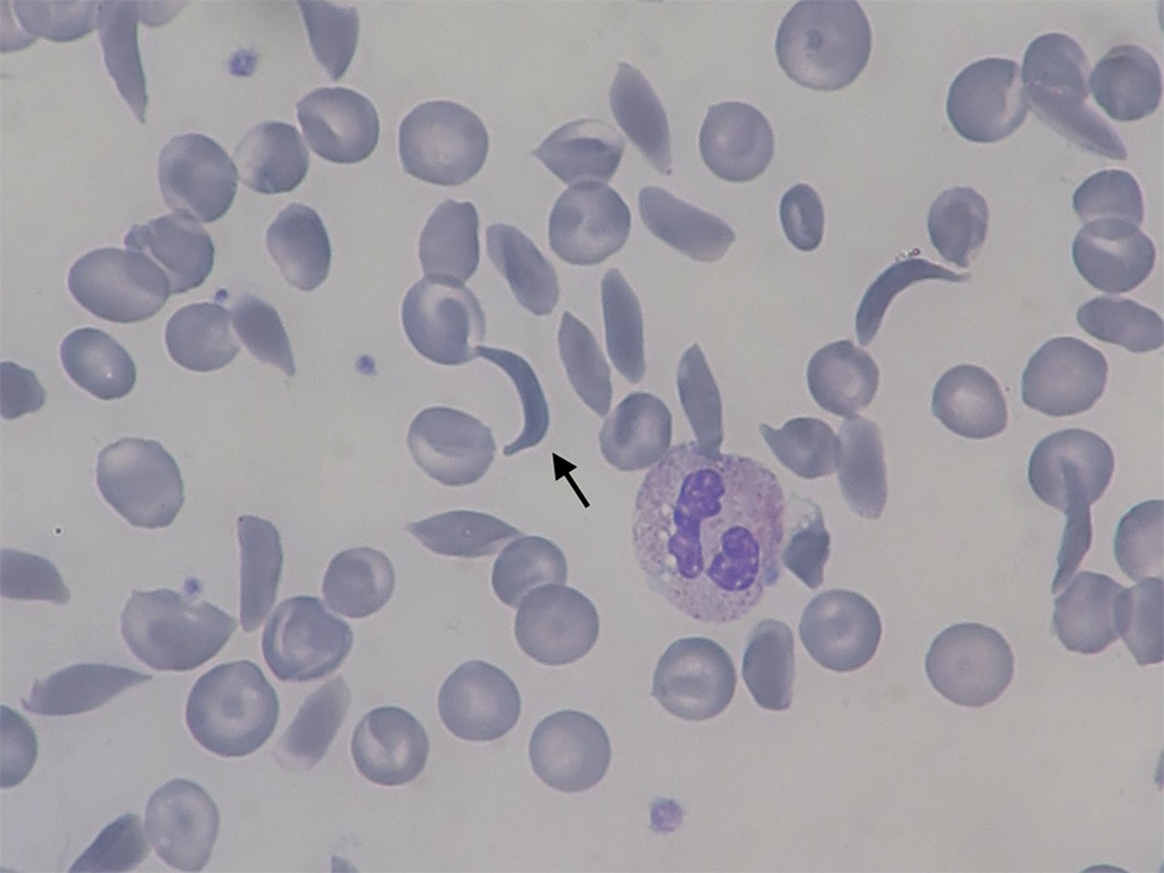 Ген серповидноклеточной анемии. Серповидноклеточная анемия. Серповидноклеточная анемия мазок крови. Серповидно клеточный эритроцит в мазке. Мазок крови при серповидноклеточной анемии.