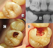 Ba bức ảnh của 1 răng sâu + 1 bức x quang.