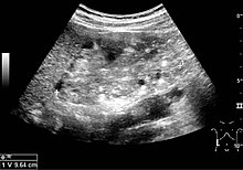 Renal ultrasonography of a person with tuberous sclerosis and multiple angiomyolipomas in the kidney: Measurement of kidney length on the US image is illustrated by '+' and a dashed line. Ultrasonography of multiple angiomyolipomas in tuberous sclerosis.jpg