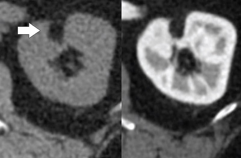File:CT of angiomyolipoma, before and after radiocontrast.jpg