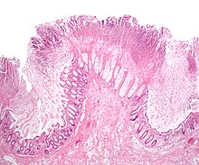 Micrograph of a colonic pseudomembrane, as may be seen in Clostridioides difficile colitis, a type of infectious colitis. Colonic pseudomembranes low mag.jpg