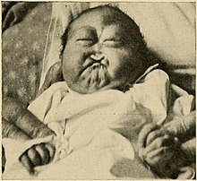 Hipotelorizm, yarık dudak ve yarık damak anormalliklerini gösteren patau sendromlu bebek