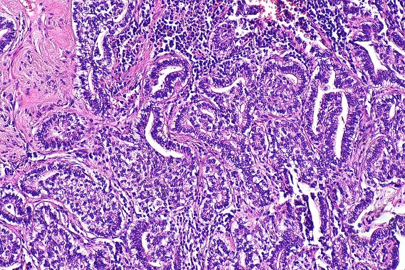 File:Fetal adenocarcinoma of the lung -- intermed mag.jpg
