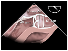 Example of quantification of the aortic root Fig009 (CardioNetworks ECHOpedia).svg