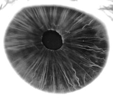 Fluorescein angiograpy of the iris reveals a radial layout of blood vessels.