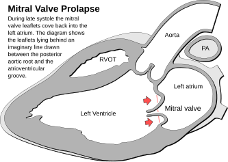 Heart mitral valve prolapse.svg