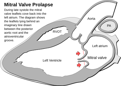 Heart mitral valve prolapse.svg