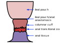 Ileal pouch-anal anastomosis.svg
