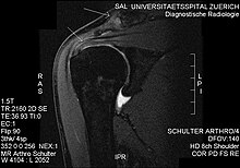 What are some symptoms of shoulder impingement syndrome?