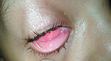 Typical membranous conjunctivitis Membranous conjunctivitis.jpg