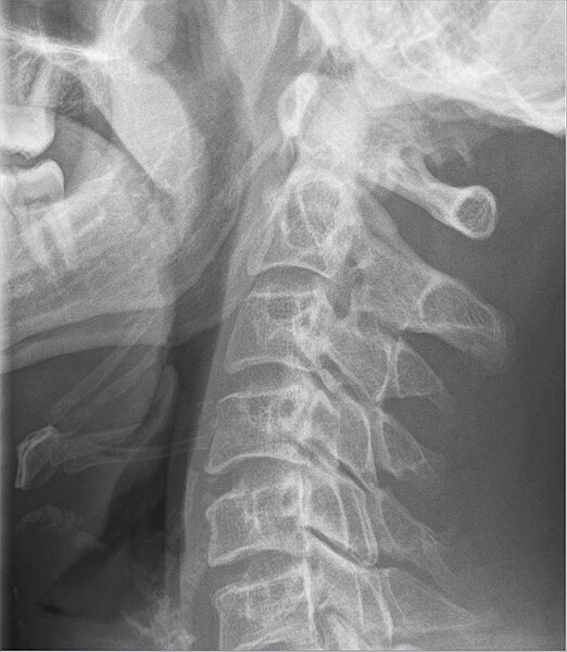 File:Ossifikation des Ligamentum stylohyoideum 35M - CR seitlich - 001.jpg