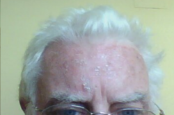 Interim result of phototherapy for actinic keratosis with Metvix one week after exposure. Patient has light skin and blue eyes.