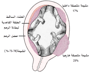 Placenta accreta-ar.png