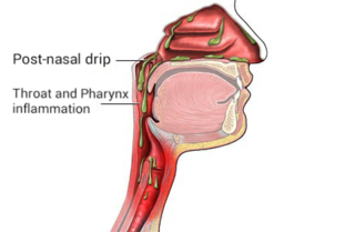 <span class="mw-page-title-main">Post-nasal drip</span> Medical condition