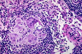 Crystalline inclusion with developing Schaumann body, polarized, in sarcoidosis Sarcoidosis - Crystalline inclusion with developing Schaumann body, polarized.jpg