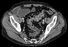 CT scan showing extensive diverticulosis of the sigmoid colon Sigmadivertikulose CT axial.jpg