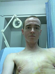 A patient six days after having top surgery Six days later (4772334014).jpg