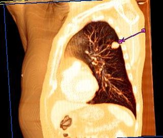 Thorax CT pcor Cut 3D Volume Rendering Haut.jpg