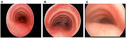 Description de l'image Tracheomalacia.jpg.