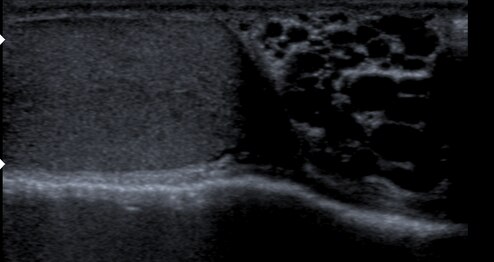Varicocele in ultrasound (left: testicle)