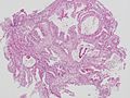 高分化型管状腺癌 (tub1)。