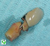 Fraktur eines entfernten, vorher bereits mit einer Stiftkrone versorgten Zahnes im Bereich des Zahnhalses. Der Zahn war früher schon reseziert worden (Wurzelspitzenresektion).