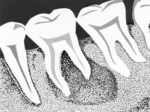 Thumbnail for File:X Ray Teeth (PSF).png