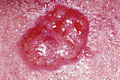 517 Basal Cell Carcinoma.jpg