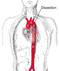 Vignette pour Dissection aortique