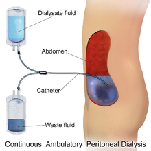 Peritoneal Dialysis Wikipedia