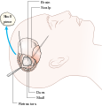 Diagram showing a craniotomy CRUK 063.svg
