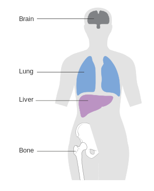 Diagram showing most common sites breast cancer spreads to CRUK 169.svg