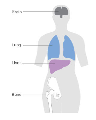 <span class="mw-page-title-main">Metastatic breast cancer</span> Type of cancer