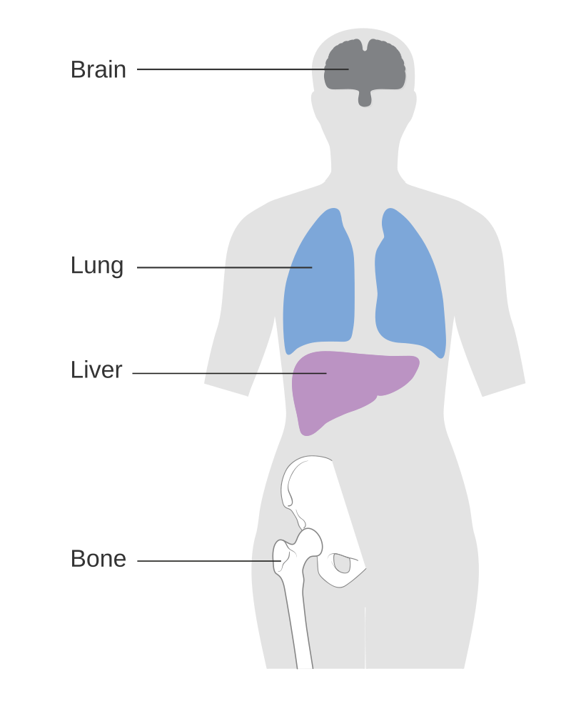 What's your diagnosis?? Metastatic breast cancer is another name