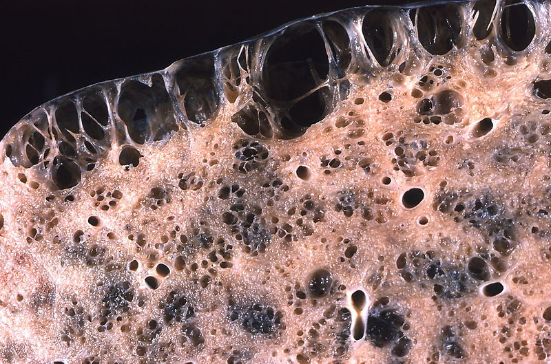 File:Emphysema, bullous, subpleural and honeycomb fibrosis (4563270966).jpg