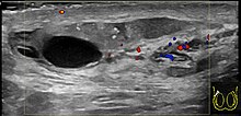 Scrotal ultrasound showing calcifications and cysts in a case of chronic epididymis. Epididymal calcifications and cyst.jpg