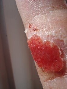 Granulation tissue after childbirth