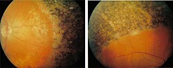 Thumbnail for Retinal degeneration (rhodopsin mutation)